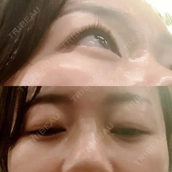 下まぶたの脂肪取り 品川美容外科 渋谷院（※品川スキンクリニック提携） DAY 22 メイン用