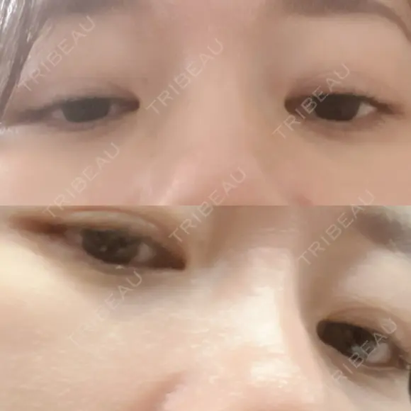 下まぶたの脂肪取り 品川美容外科 渋谷院（※品川スキンクリニック提携） DAY 23 メイン用