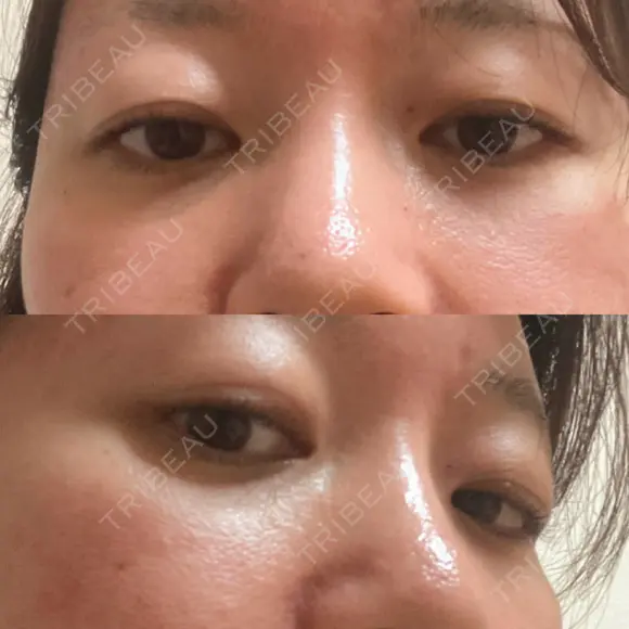 下まぶたの脂肪取り 品川美容外科 渋谷院（※品川スキンクリニック提携） DAY 25 メイン用