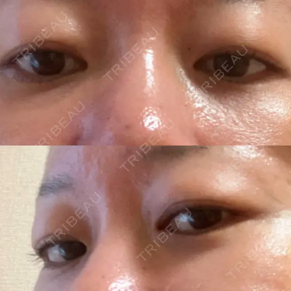 下まぶたの脂肪取り 品川美容外科 渋谷院（※品川スキンクリニック提携） AFTER メイン用