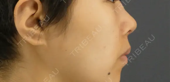 隆鼻術 / 鼻尖形成（切開） / 鼻中隔延長（切開） GRACIA clinic 【グラシアクリニック】 DAY 49 メイン用