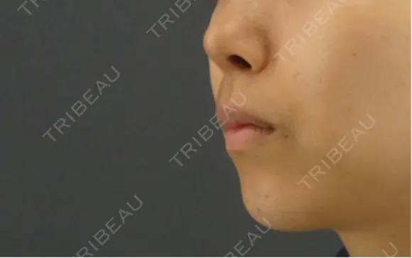 隆鼻術 / 鼻尖形成（切開） / 鼻中隔延長（切開） GRACIA clinic 【グラシアクリニック】 DAY 49 メイン用