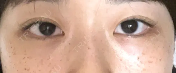 クマ治療 / 下まぶたの脂肪取り / ボトックス（エラ・小顔） / ボトックス（肩） TCB東京中央美容外科 大宮西口院 AFTER メイン用