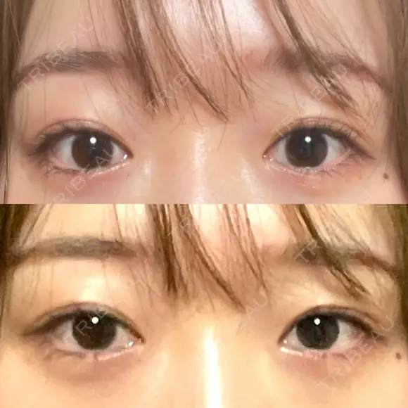 二重埋没 水の森美容クリニック 大阪梅田院 DAY 1125 メイン用