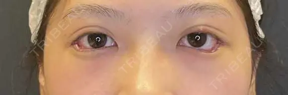 二重埋没 / 目尻切開 / タレ目形成・グラマラスライン（埋没） LOUIS CLINIC 二子玉川院【ルイクリニック】 DAY 0 メイン用