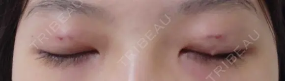 二重埋没 / 目尻切開 / タレ目形成・グラマラスライン（埋没） LOUIS CLINIC 二子玉川院【ルイクリニック】 DAY 0 メイン用