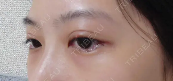 二重埋没 / 目尻切開 / タレ目形成・グラマラスライン（埋没） LOUIS CLINIC 二子玉川院【ルイクリニック】 DAY 0 メイン用