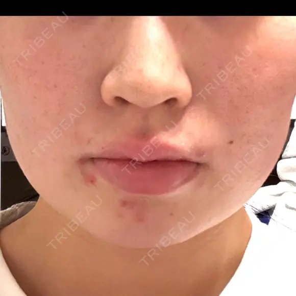 ボトックス（エラ・小顔） BiBiクリニック AFTER メイン用