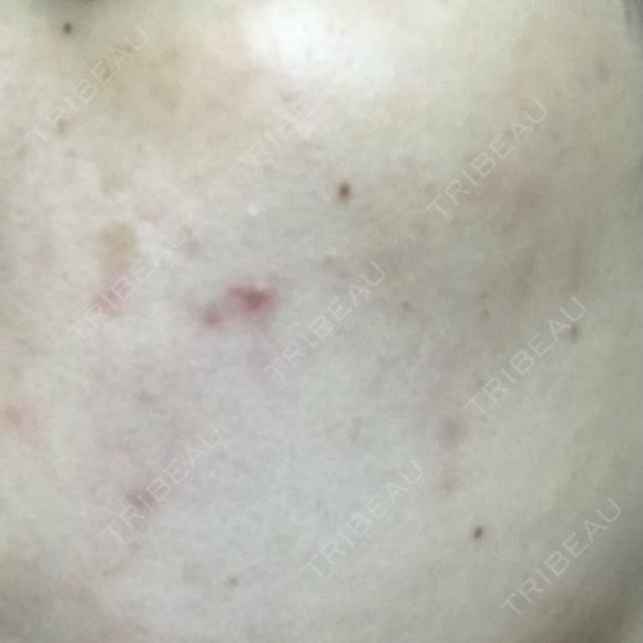 医療脱毛（全身） / ルメッカ Grias clinic （ジリアスクリニック） AFTER メイン用