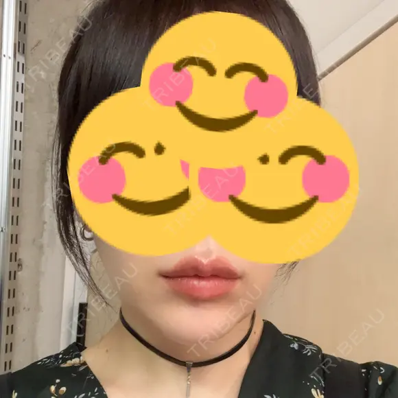 RF（高周波）たるみ治療 Clinic K Blossom AFTER メイン用