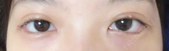 二重埋没 / 目尻切開 / タレ目形成・グラマラスライン（埋没） LOUIS CLINIC 二子玉川院【ルイクリニック】 DAY 1 メイン用