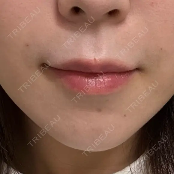 肌ヒアルロン酸注入（たるみ・シワ改善） KIMI CLINIC 形成・美容外科 AFTER メイン用