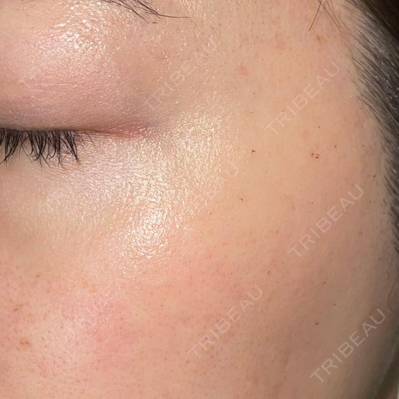 ピーリング（ハリ・ツヤ） / ルメッカ PureMe Skin Clinic（ピュアミースキンクリニック麻布） DAY 3 メイン用