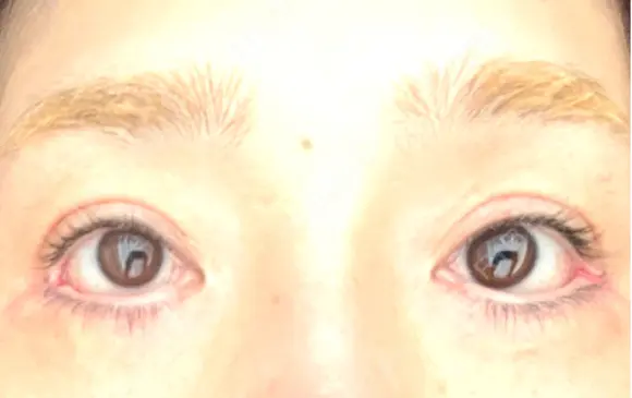 目尻切開 / タレ目形成・グラマラスライン（埋没） LOUIS CLINIC 二子玉川院【ルイクリニック】 DAY 1 メイン用