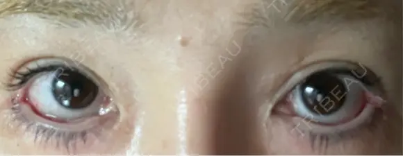 目尻切開 / タレ目形成・グラマラスライン（埋没） LOUIS CLINIC 二子玉川院【ルイクリニック】 DAY 4 メイン用