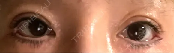 目尻切開 / タレ目形成・グラマラスライン（埋没） LOUIS CLINIC 二子玉川院【ルイクリニック】 AFTER メイン用