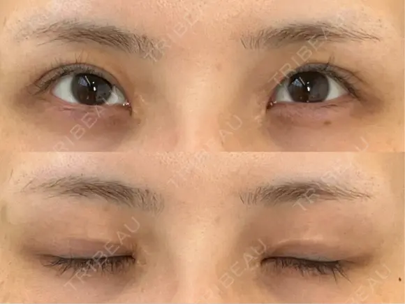 二重切開 / 眼瞼下垂（切開） / スレッドノーズ / ヒアルロン酸注入（鼻翼基部） オーキッド美容クリニック東京御徒町 DAY 240 メイン用