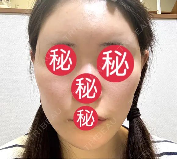 額を丸く / 脂肪注入（肌） / 脂肪注入（額） 湘南美容クリニック 柏院 DAY 61 メイン用