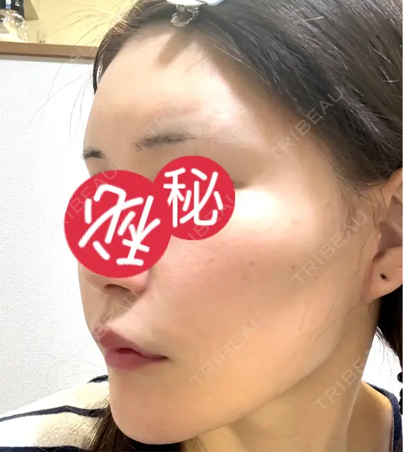 額を丸く / 脂肪注入（肌） / 脂肪注入（額） 湘南美容クリニック 柏院 DAY 61 メイン用