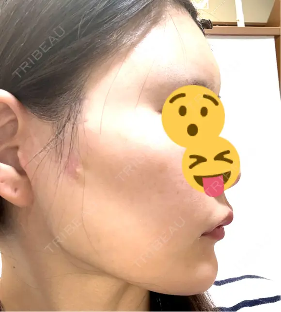 額を丸く / 脂肪注入（肌） / 脂肪注入（額） 湘南美容クリニック 柏院 DAY 61 メイン用