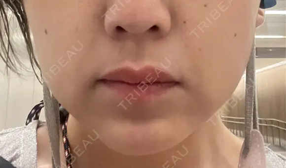 ボトックス（あご） / ボトックス（エラ・小顔） / 脂肪溶解注射（顔） / ボトックス（人中） Kinshicho Beauty Clinic （錦糸町ビューティークリニック） DAY 6 メイン用