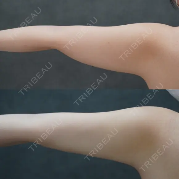 脂肪吸引（顔） / 脂肪吸引（二の腕） / 脂肪吸引（脚） / 脂肪吸引（お腹） / 脂肪吸引（お尻） / 脂肪吸引（腰） / 脂肪吸引（背中） / 脂肪吸引（肩） ヴェルトラクリニック 新宿院 AFTER メイン用