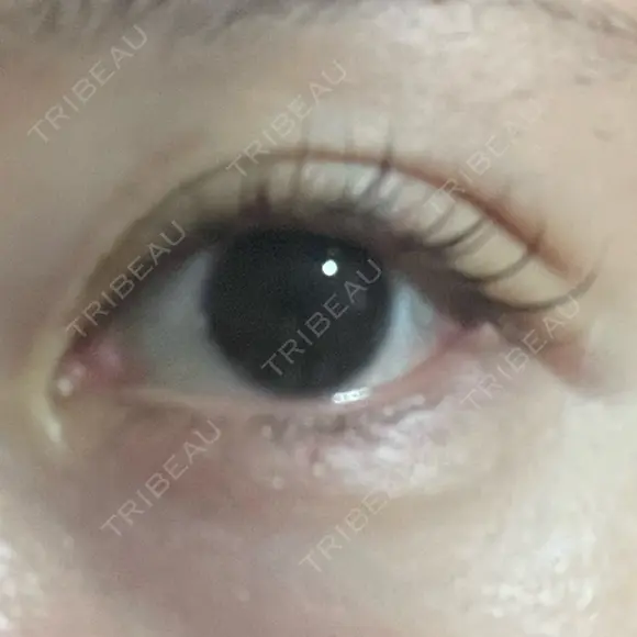 眼瞼下垂（非切開） SOL CLINIC AFTER メイン用