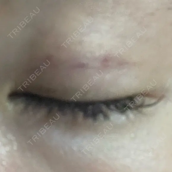 眼瞼下垂（非切開） SOL CLINIC DAY 8 メイン用