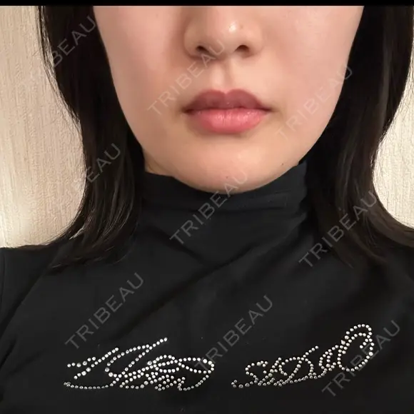 ボトックス（エラ・小顔） 共立美容外科 大阪本院 DAY 0 メイン用