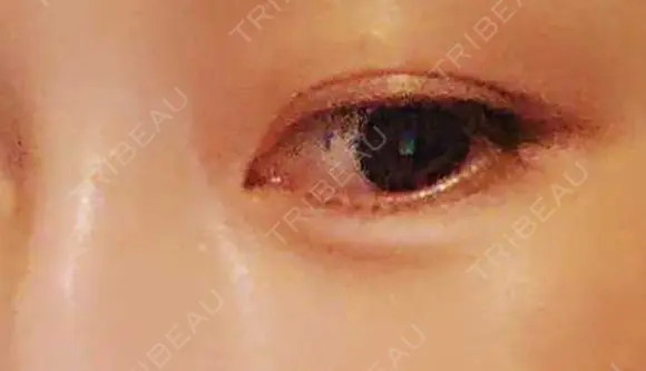 ヒアルロン酸注入（涙袋） ルラ美容クリニック 福岡本院 DAY 3 メイン用