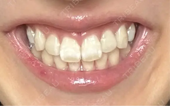 ボトックス（ガミースマイル） RAISE CLINIC 【レイズクリニック】 AFTER メイン用