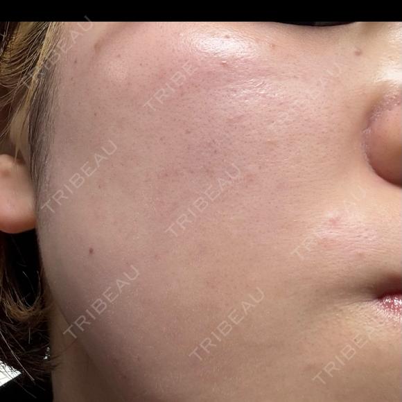 ピーリング（ハリ・ツヤ） / ルメッカ PureMe Skin Clinic（ピュアミースキンクリニック麻布） DAY 0 メイン用