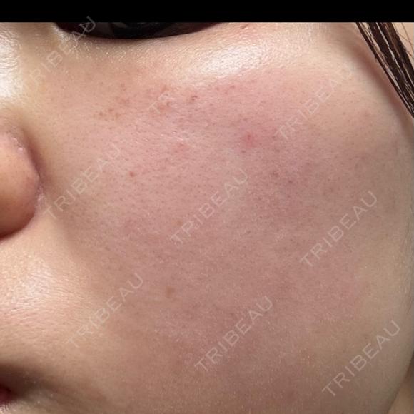 ピーリング（ハリ・ツヤ） / ルメッカ PureMe Skin Clinic（ピュアミースキンクリニック麻布） DAY 0 メイン用