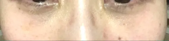 クマ治療 / 下まぶたたるみ取り 二子玉川美容外科クリニック DAY 9 メイン用