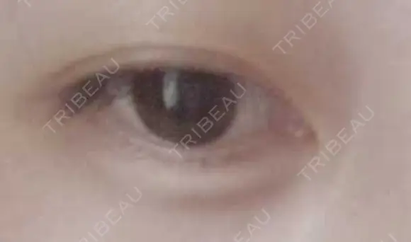 ヒアルロン酸注入（涙袋） ルラ美容クリニック 福岡本院 AFTER メイン用