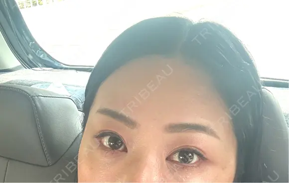 クマ治療 EMMO FACE CLINIC 東京三田院 DAY 35 メイン用
