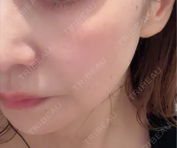 肌ヒアルロン酸注入（たるみ・シワ改善） DMTC美容皮膚科 大宮院 AFTER メイン用