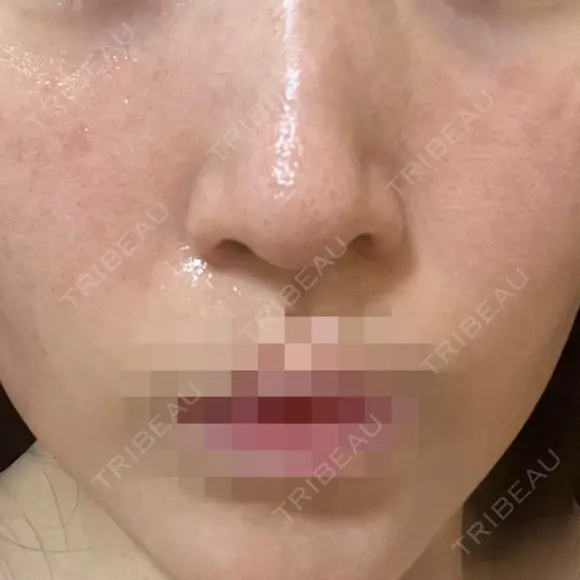 ポテンツァ ルラ美容クリニック 岡山院 DAY 2 メイン用