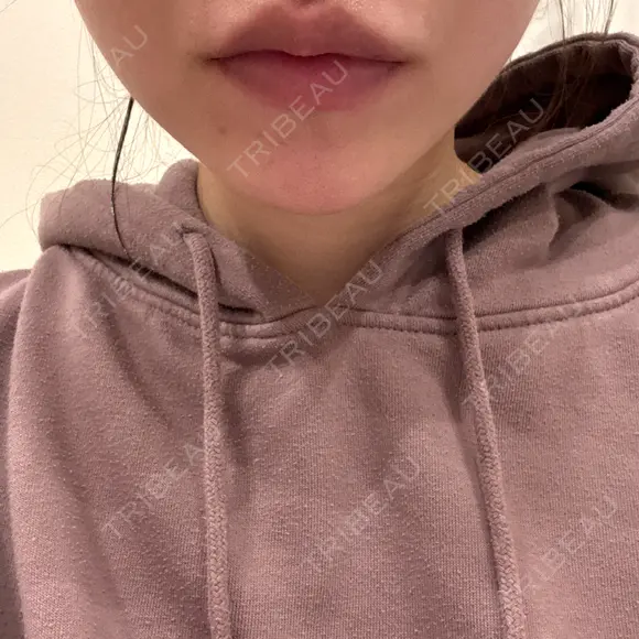 ヒアルロン酸注入（涙袋） / 脂肪溶解注射（顔） 麻布十番クレールデンタルクリニック AFTER メイン用