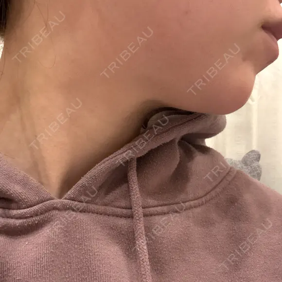 ヒアルロン酸注入（涙袋） / 脂肪溶解注射（顔） 麻布十番クレールデンタルクリニック DAY 0 メイン用