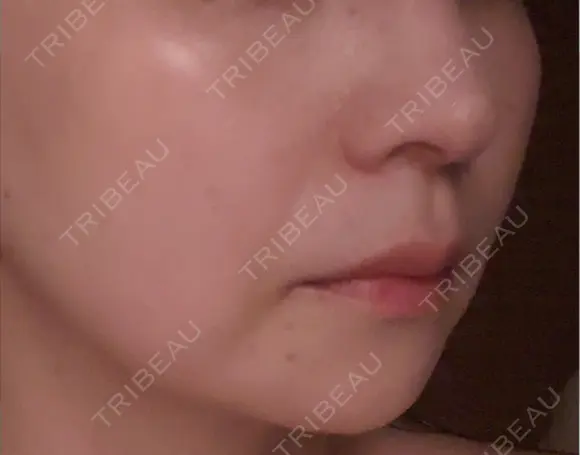 肌ヒアルロン酸注入（たるみ・シワ改善） DMTC美容皮膚科 大宮院 DAY 0 メイン用