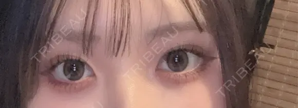 目頭切開 シンデレラ＆ダヴィンチクリニック AFTER メイン用