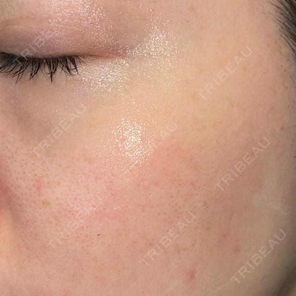ピーリング（ハリ・ツヤ） / ルメッカ PureMe Skin Clinic（ピュアミースキンクリニック麻布） AFTER メイン用