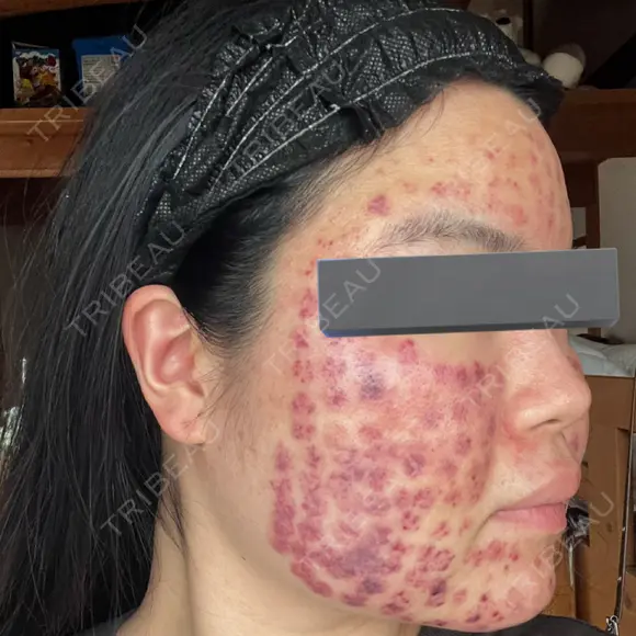 美肌レーザー / 赤み除去レーザー / ニキビ治療 医療法人河田外科形成外科 DAY 0 メイン用
