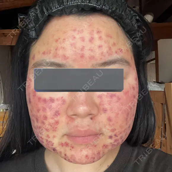 美肌レーザー / 赤み除去レーザー / ニキビ治療 医療法人河田外科形成外科 DAY 0 メイン用