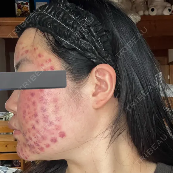 美肌レーザー / 赤み除去レーザー / ニキビ治療 医療法人河田外科形成外科 DAY 0 メイン用