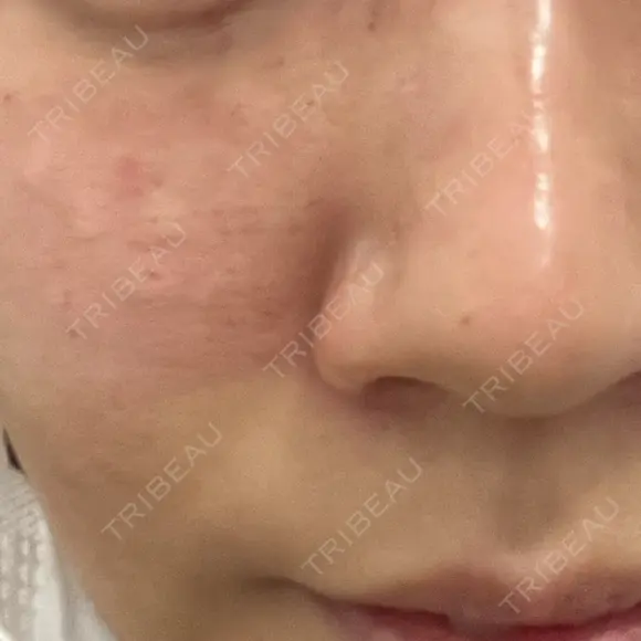 肌育注射（ジュベルックなど） 城本クリニック 長野院 AFTER メイン用