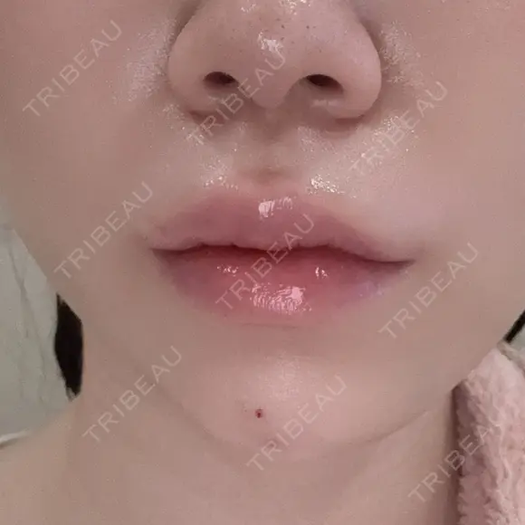 ヒアルロン酸注入（あご） / ヒアルロン酸注入（唇） / ボトックス（口角） ルラ美容クリニック 大阪本院 DAY 0 メイン用