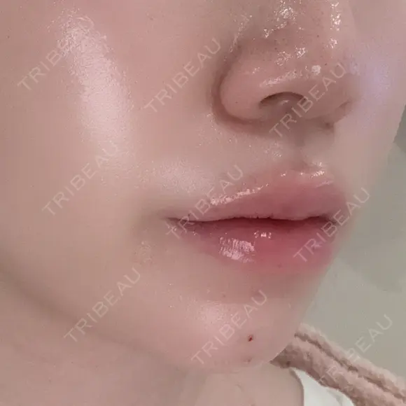 ヒアルロン酸注入（あご） / ヒアルロン酸注入（唇） / ボトックス（口角） ルラ美容クリニック 大阪本院 DAY 0 メイン用