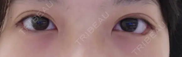 二重埋没 / 目尻切開 / タレ目形成・グラマラスライン（埋没） LOUIS CLINIC 二子玉川院【ルイクリニック】 DAY 6 メイン用